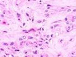 上皮樣血管內皮細胞瘤