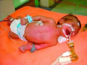 小兒呼吸衰竭 小兒呼吸衰竭