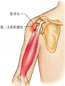 肱二頭肌長頭肌腱炎 肱二頭肌長頭肌腱炎