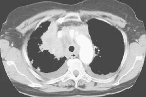 肝靜脈阻塞綜合徵