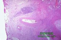 假膜性腸炎 假膜性腸炎