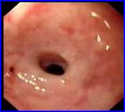 先天性食管狹窄