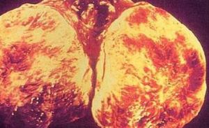 卵泡膜細胞瘤 卵泡膜細胞瘤