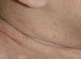 嬰兒熱痱 嬰兒熱痱