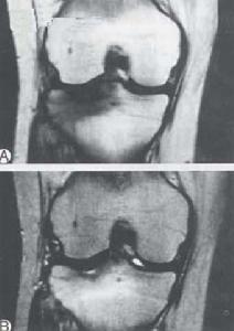 （圖）膝關節自發性骨壞死