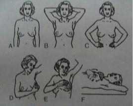 乳頭內陷矯正 乳頭內陷矯正