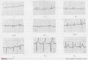 心房擴大 心房擴大