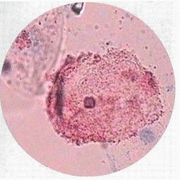 細菌性陰道炎 細菌性陰道炎