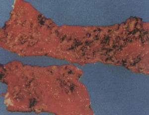 豬痢疾病變腸道