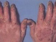 關節型銀屑病 關節型銀屑病