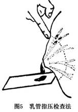 （圖）乳房導管內乳頭狀瘤