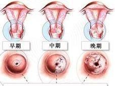 女陰多毛狀乳頭瘤 女陰多毛狀乳頭瘤