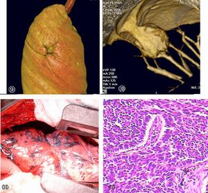 支氣管肺泡灌洗術