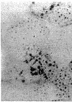 脂質沉積性肌病