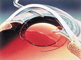 超聲乳化白內障手術 超聲乳化白內障手術