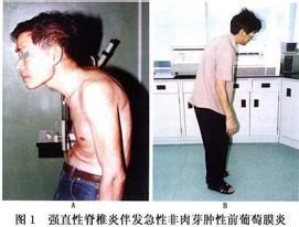 強直性脊柱炎及其伴發的葡萄膜炎 強直性脊柱炎及其伴發的葡萄膜炎