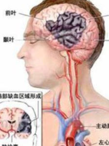腦梗死 腦梗死