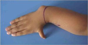 先天性尺骨缺如 先天性尺骨缺如