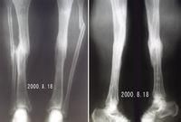 先天性脛骨假關節