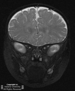 胼胝體發育不全症 胼胝體發育不全症