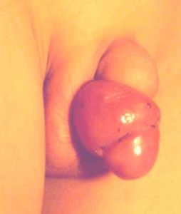 嵌頓包莖 嵌頓包莖