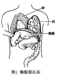 先天性胸骨旁疝