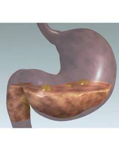 化膿性胃炎 化膿性胃炎