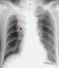 中央型肺癌