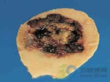 朗漢斯細胞的組織細胞增多症