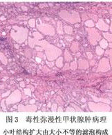甲狀腺瀰漫性病變 甲狀腺瀰漫性病變