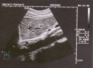 爆發性肝功能衰竭