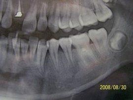 根尖誘導成形術 根尖誘導成形術