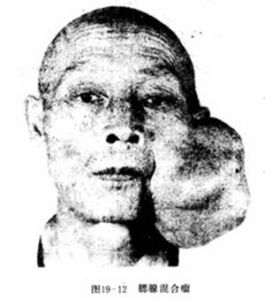 頜骨造釉細胞瘤 頜骨造釉細胞瘤