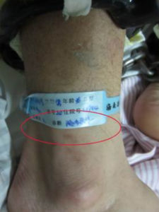 顱內非特異性感染