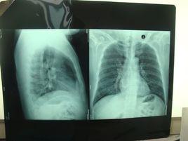 隱源性機化性肺炎 隱源性機化性肺炎