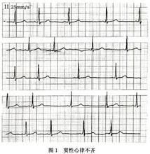 小兒竇性心律失常 小兒竇性心律失常