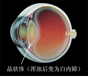 《白內障的診斷與治療》