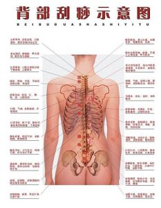 背部刮痧示意圖