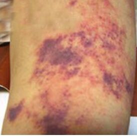 束臂試驗 束臂試驗