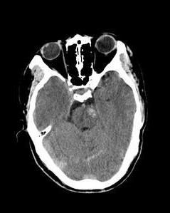 原發性腦幹損傷 原發性腦幹損傷