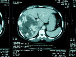 肝上皮樣血管內皮細胞瘤