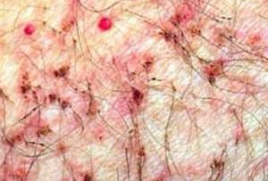 龜頭糜爛 龜頭糜爛