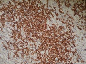 愛滋病性頸淋巴結腫大