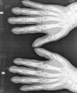 肥大性骨關節病