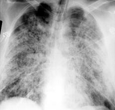 肺出血-腎炎綜合徵