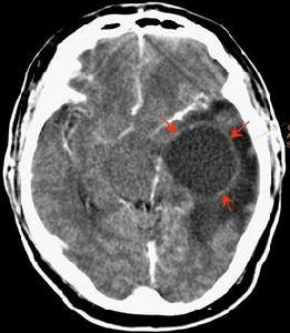 惡性腦瘤 惡性腦瘤