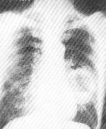 支氣管肺癌