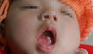 （圖）棄嬰嘴裡長腫瘤