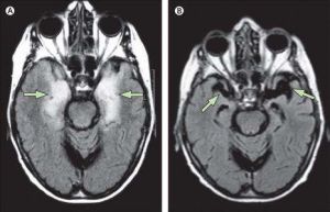 患了病毒性腦炎的檢查