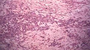 上皮樣肉瘤 上皮樣肉瘤